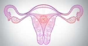 What you need to know about Ovarian Hyperstimulation Syndrome  (OHSS)