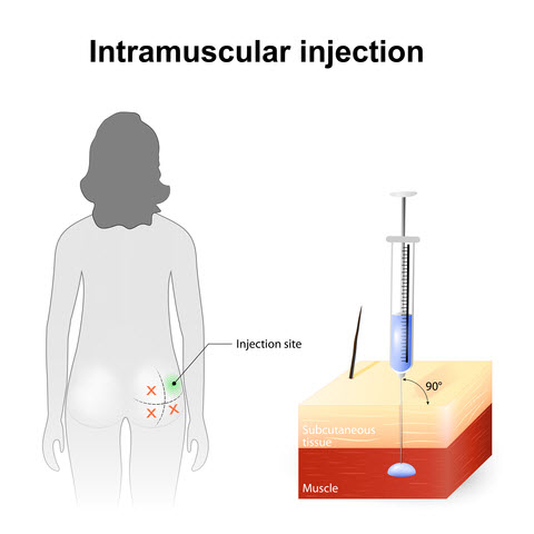 Intramuscular Injection Site IVF PIO