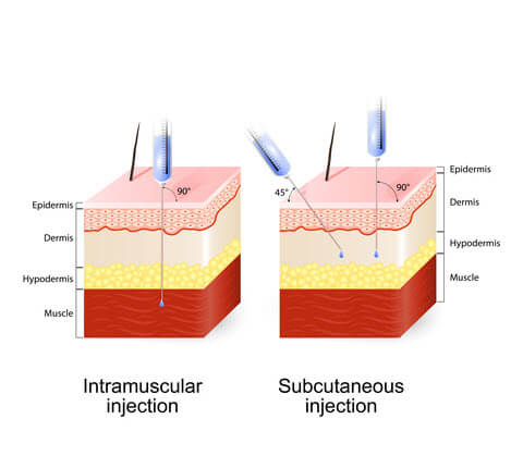 subcutaneous intramuscular injection for IVF